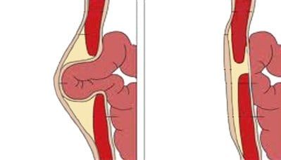 Ilustración del corte de una hernia en la pared abdominal
